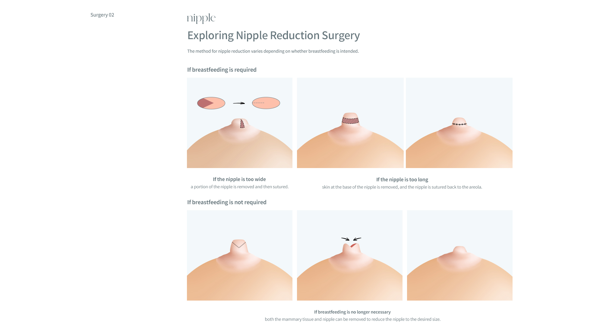 Areola/Nipple