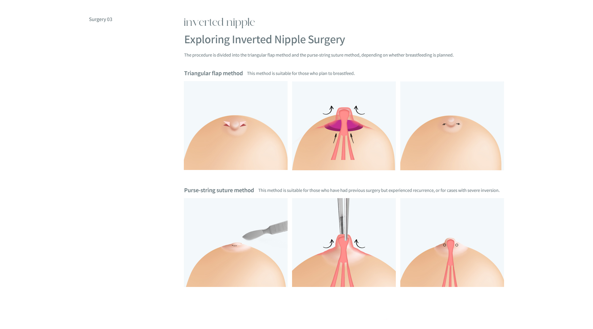 Areola/Nipple